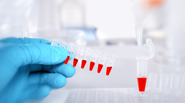 Parkinson’s disease biomarkers