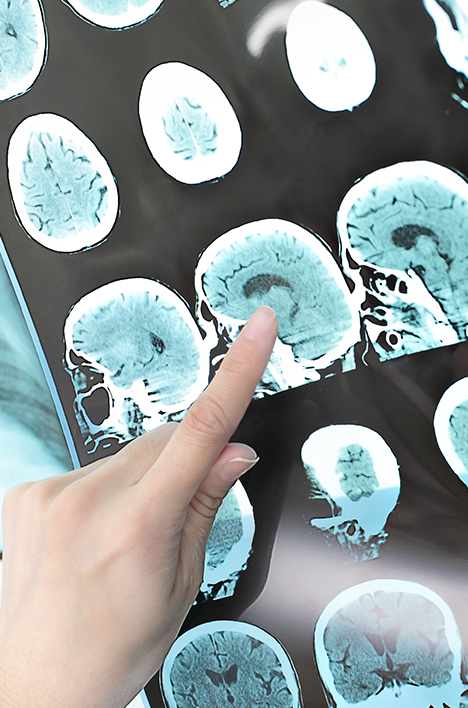 finger pointing to an xray scan of brain