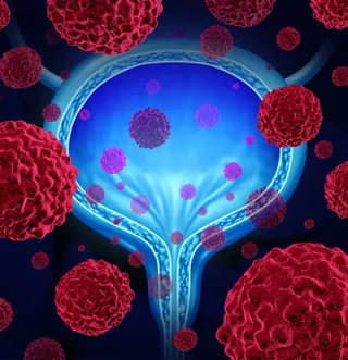 Discover how Worldwide supports complex bladder cancer trials.