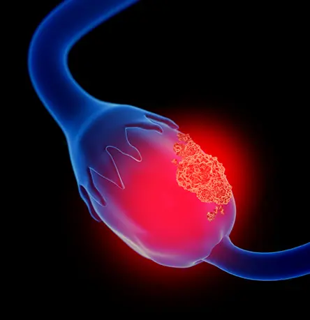 From At-Risk to Completion: A Global Phase III Ovarian Cancer Study Turnaround