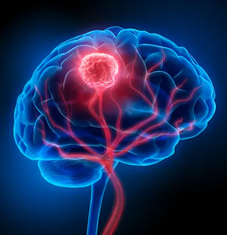 Rapid FPI Milestone for Brain Cancer Trial