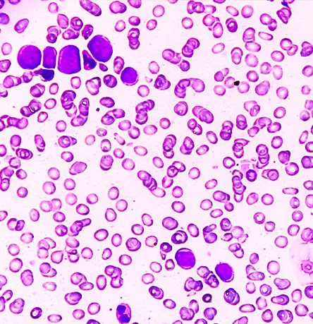 Successful Partnership Advances AML Program to Phase II/III